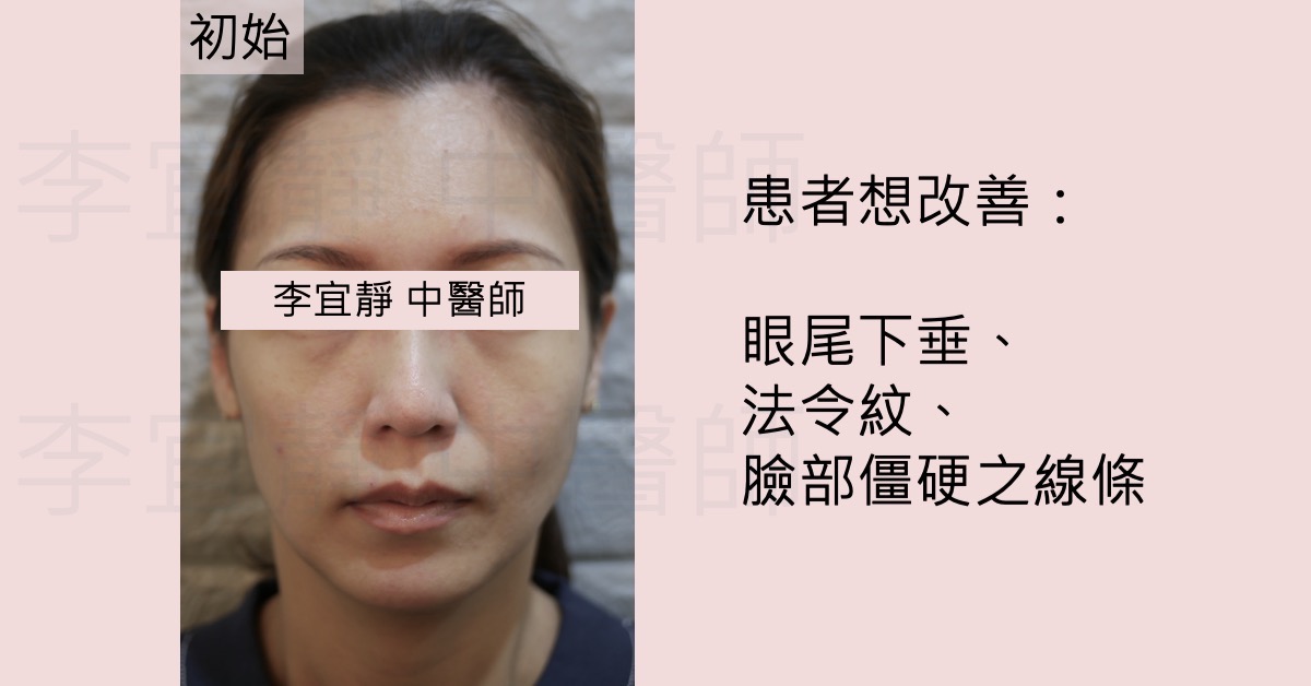 【美顏針案例分享】瘦人也能擁有澎潤蘋果肌與柔和線條