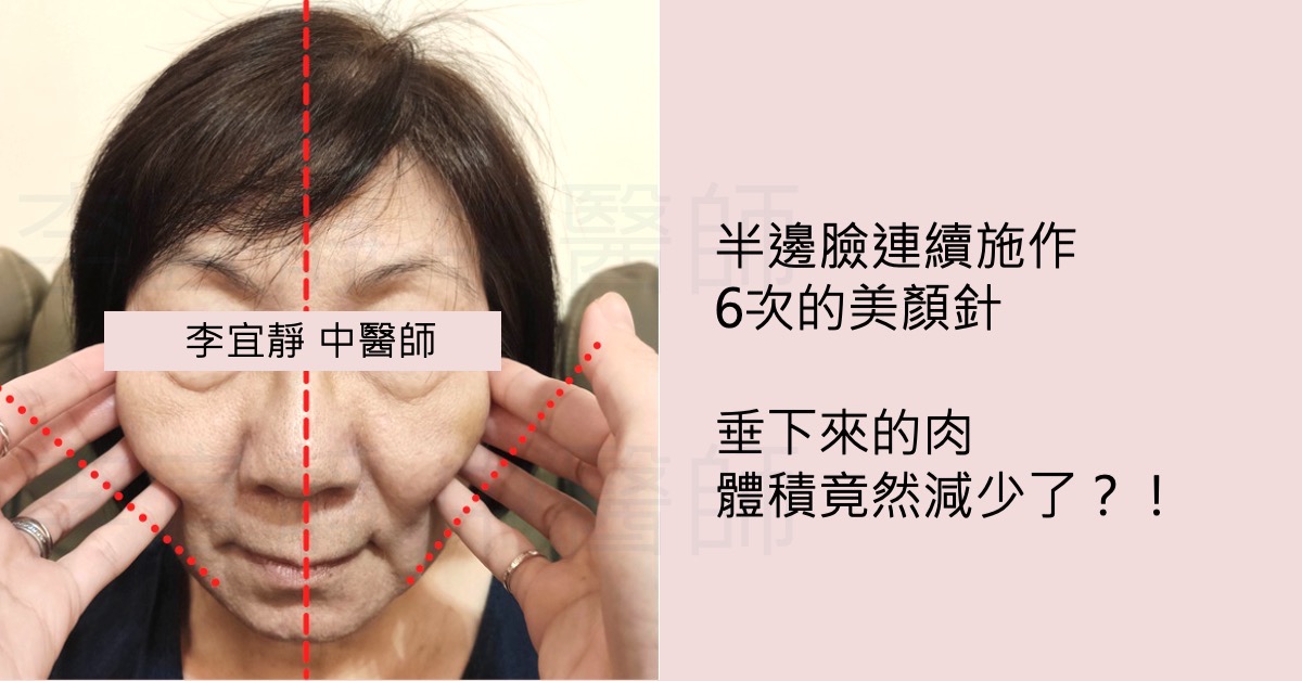 【美顏針案例分享】痰濕體質改善鬆垮臉，恢復緊緻線條