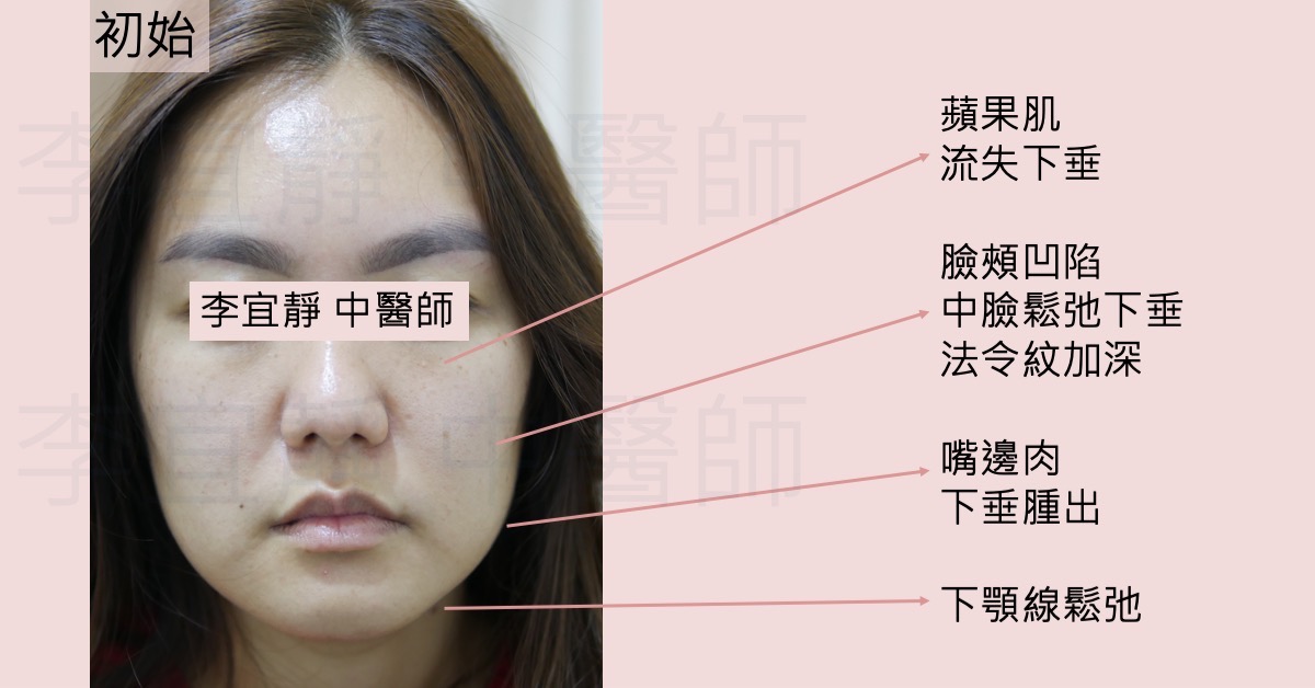 【美顏針案例分享】初老肌膚拉提緊緻，重拾青春輪廓