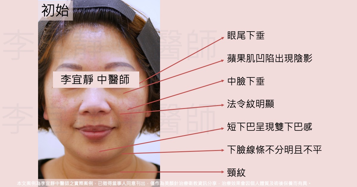 【美顏針案例分享】短下巴與頸紋改善，立體輪廓再現