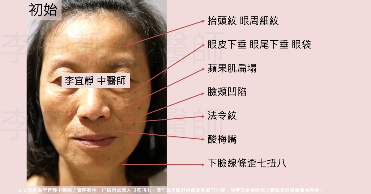 【美顏針案例分享】乾肌瘦人：細紋淡化與下垂改善