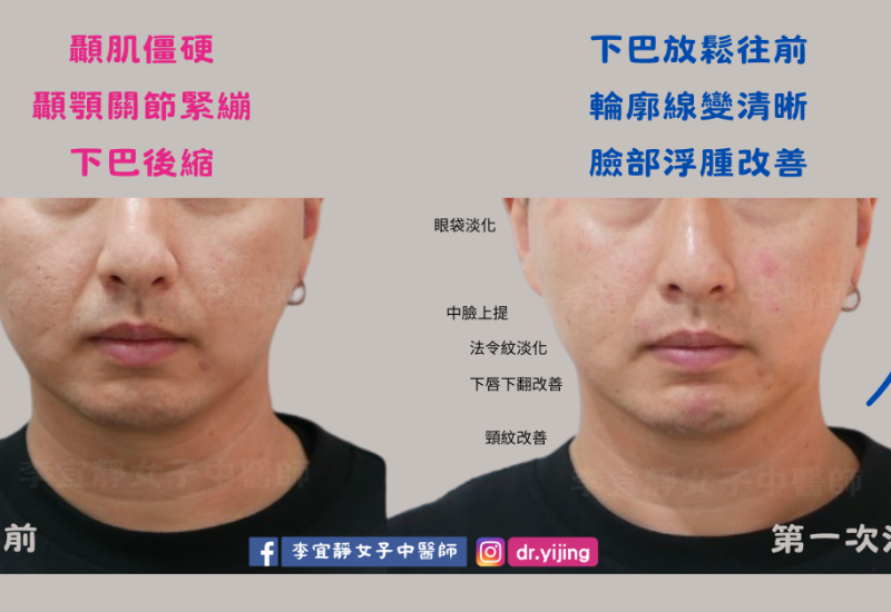 顳顎關節緊繃 (1).png